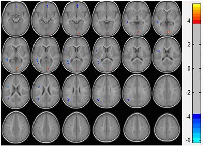 Alterations of Regional Homogeneity in Preschool Boys With Autism Spectrum Disorders